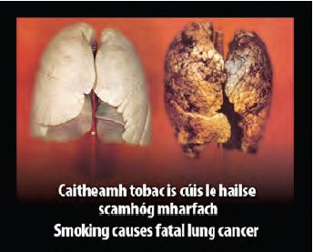 Ireland 2013 Health Effects Lungs - diseased organ, lung cancer, gross